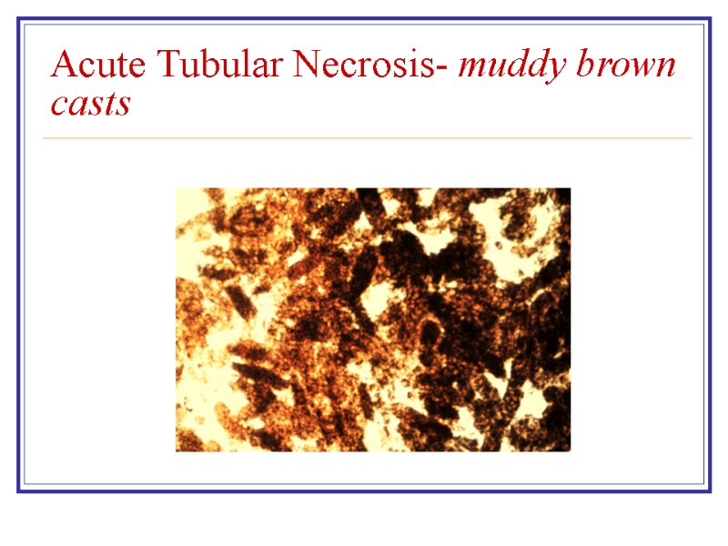 Acute Tubular Necrosis- muddy brown casts